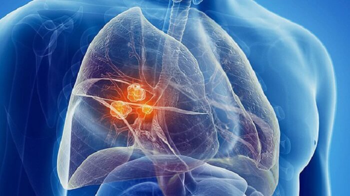 Chẩn đoán Ung thư phổi gồm phương pháp