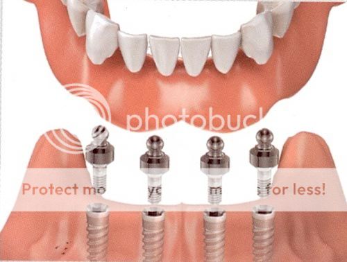 Làm răng sứ Implant có kén người hay không