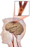 Nhận biết triệu chứng tai biến mạch máu não nhẹ